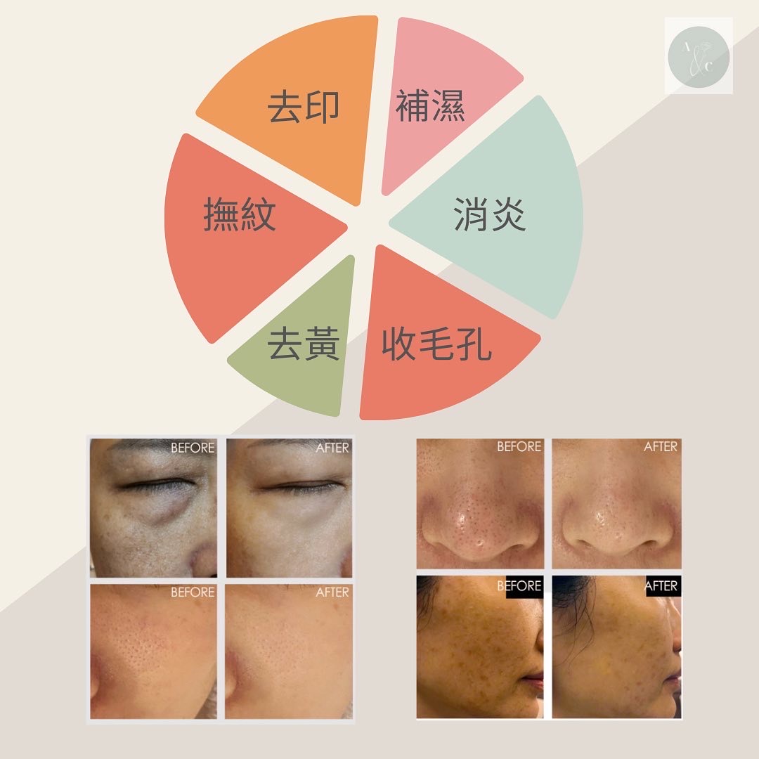 EP 微針射頻殫平凹凸洞月球肌 介紹 2
