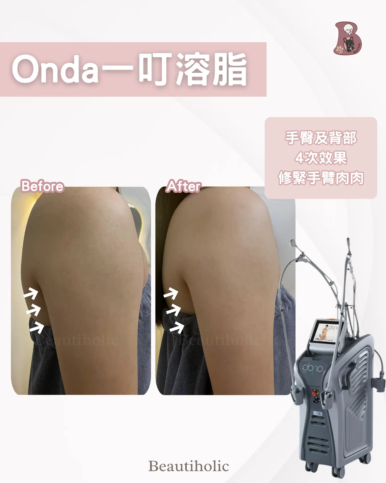 Onda 一叮溶脂 客戶見證 療程介紹 1