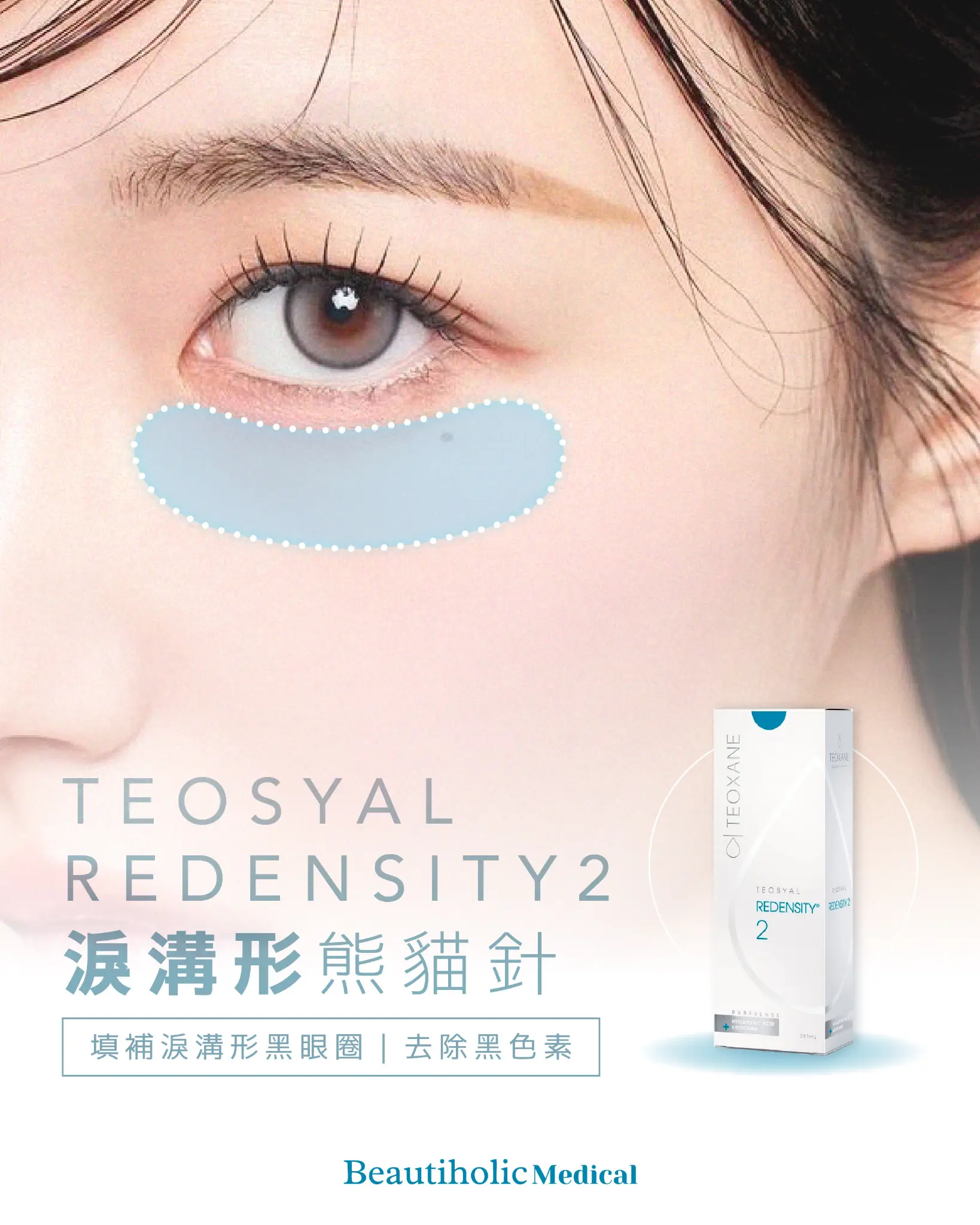 Teosyal R2 淚溝型熊貓針 1