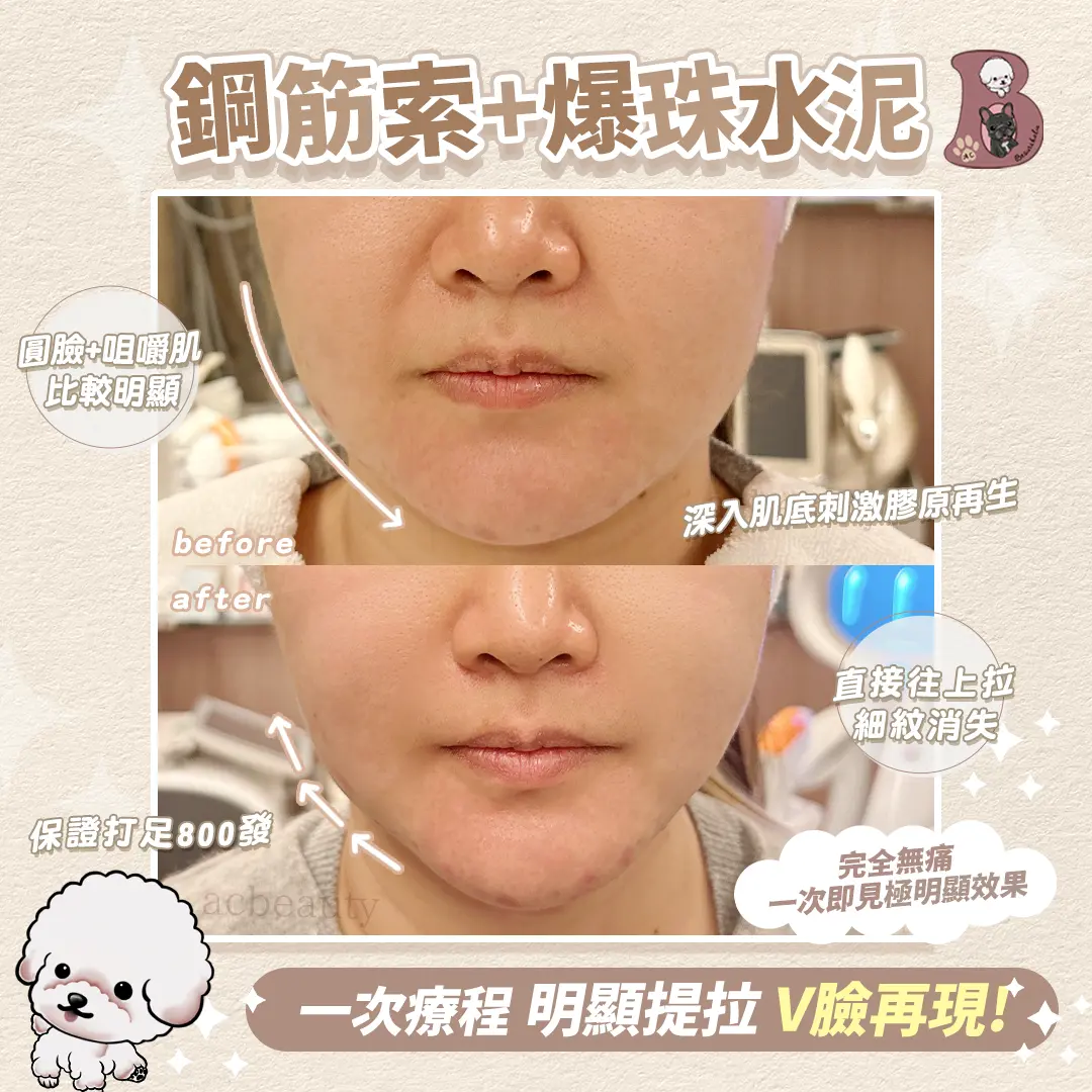 Ultraformer 4 MPT 客戶見證 療程介紹 1